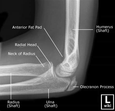 Pediatric Elbow Anatomy Radiologypicscom
