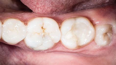 Common Reasons For Tooth Removal Include The Eruption Of A Wisdom Tooth
