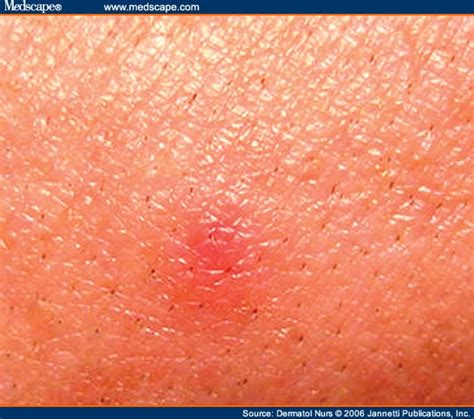 Skin Rashes In A Patient With Antibodies To Ross A