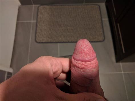 Rash On Penis Head Only After Sex Can Anyone Help Identify We Use A