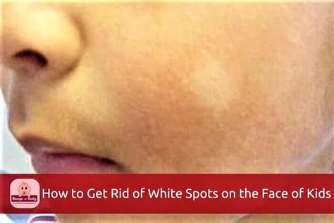 How To Get Rid Of White Spots On The Face Of Babies And Kids