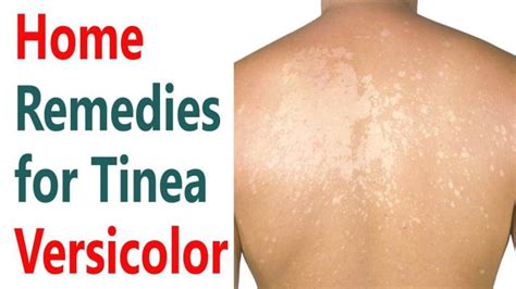 Home Remedies For Tinea Versicolor 500 Health