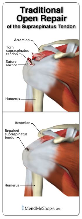 The rotator cuff tendons and rotator cuff muscles play a pretty important role since they are what keeps the arm in the shoulder socket. MendMeShop - Surgical Rotator Cuff Treatment Options