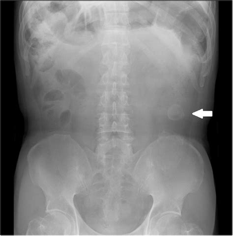 Plain Abdominal Radiograph Showing Air Bowel Distention In The Upper