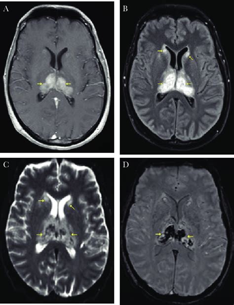 A T1 B T2 C Diffusion Weighted Imaging D Susceptibility