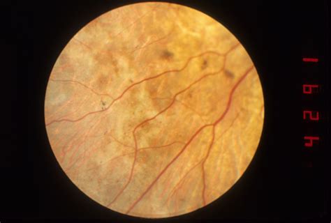 Choroideremia Hereditary Ocular Diseases
