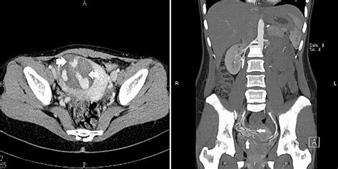 An Abdominal Contrast Material Enhanced Computed Tomography Ct Scan