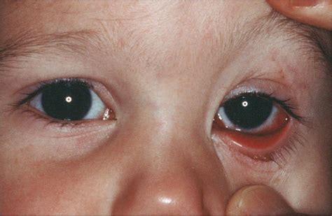 Pink eye is a common eye problem in toddlers. 6 Things to Know About Conjunctivitis in Children (pink ...
