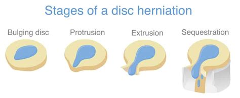 Herniated Disc Definition Causes Symptoms Diagnosis And Treatment Spine Info