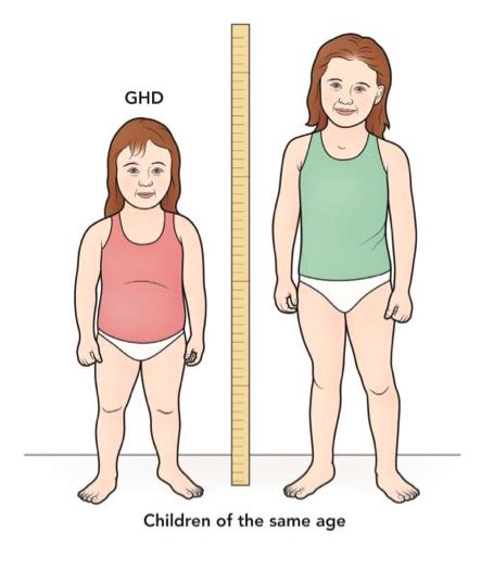 Growth Hormone Deficiency Dwarfism