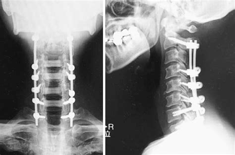 Figure1cervical Spine Radiography Demonstrating The C2 T1 Posterior