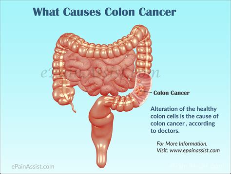 Numerous manifestations can demonstrate colon cancer, yet in the event that somebody has these indications, it doesn't really imply that they. Causes and Symptoms of Colon Cancer or Cancer of the Colon