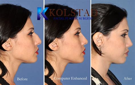 Hispanic Rhinoplasty Before And After Gallery 4 Dr Kolstad San Diego