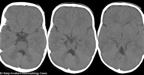Neuroradiology Cases Joubert Syndrome Ct Brain