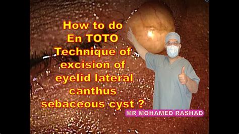 How To Do En Toto Technique For Excision Of Lateral Canthus Eyelid