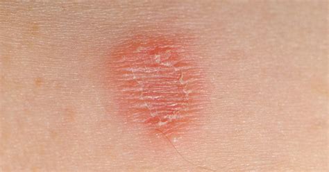 Skin Lesions Causes