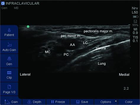 Ultrasound Guided Infraclavicular Brachial Plexus Block Anesthesia Key