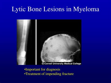 Ppt Diagnosis And Treatment Of Multiple Myeloma Powerpoint