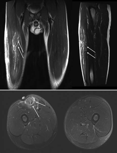 chronic and recurrent rectus femoris central tendon ruptures in athletes clinical picture mri