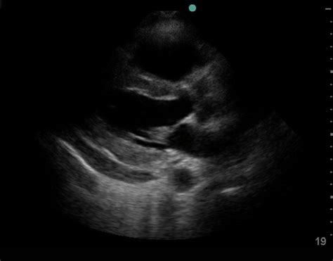 Parasternal Long Axis View Showing Pericardial Effusion Posterior To