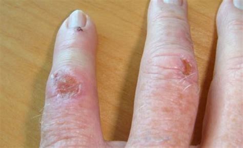 Best Fungal Infections Treatment Clinic In Delhi Fungal Infection