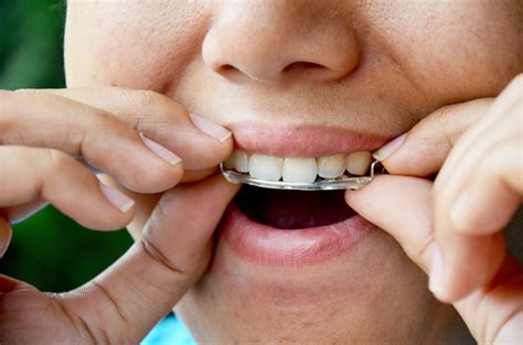 He or she may able to make the adjustments a bit differently. How Long Do You Have To Wear Retainers After Braces?