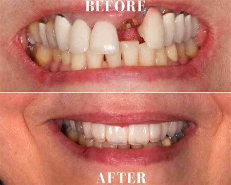 Case 4 Tooth Implant Front Tooth Ocean Breeze Prosthodontics