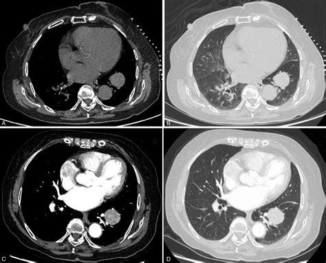 Chest Ct Scan Showed A Well Defined Nodule In The Lower Left Lung