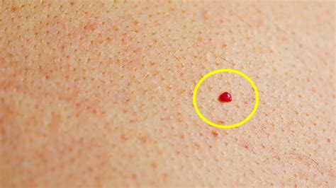 Do You Have Red Spots On Your Skin Heres What They Mean Youtube