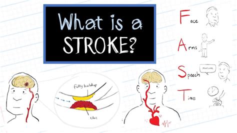 What Is A Stroke Healthsketch Youtube