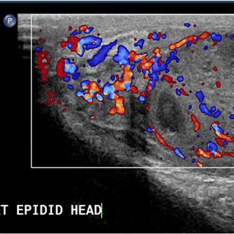 Doppler Ultrasound Image Showing The Severe Hyperemia Also Involving