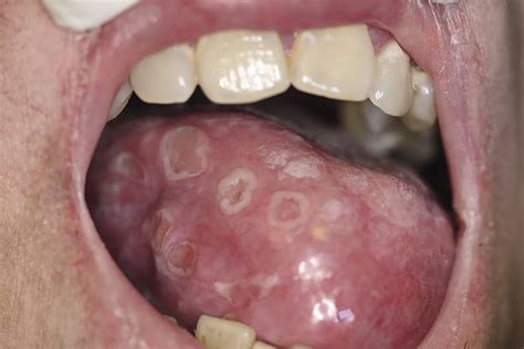 Сифилис во рту симптомы и лечение