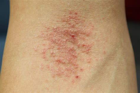 Tips Curing Disease Eczema Skin Causes Symptoms Types