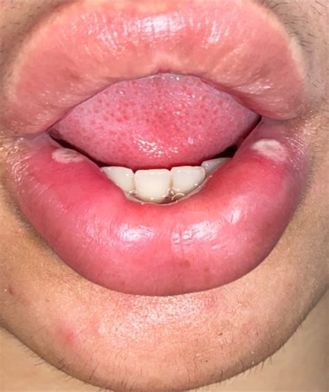 These ulcers may or may not crust over, depending on tongue movement and the amount of saliva present. Oral herpes | Herpes - Non Genital | Forums | Patient