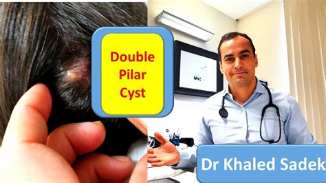 Two Pilar Cysts Removed Dr Khaled Sadek Youtube