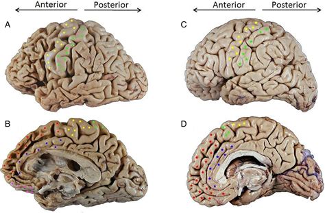 The behavioural variant frontotemporal dementia (bvFTD) syndrome in ...