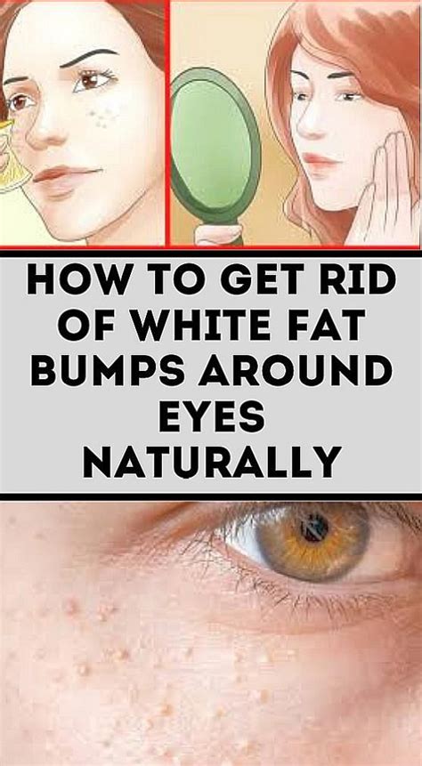 The Small White Bumps On Your Skin Which Often Look Around The Nose