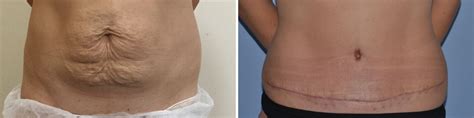 Mini Tummy Tuck Before And After Scars Cosmetic Surgery Tips