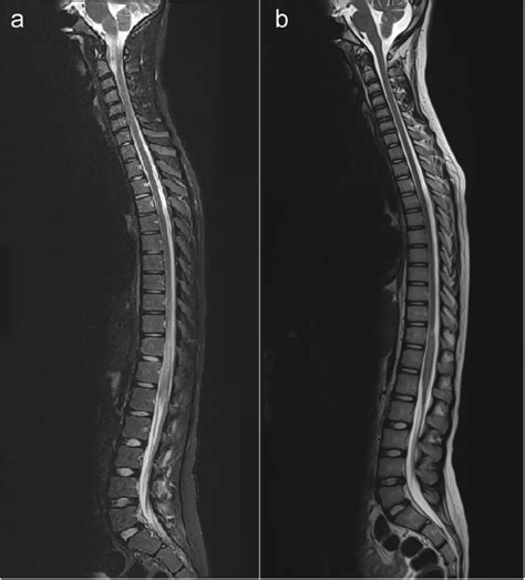 Neuroschistosomiasis mimicking lower back pain: case ...