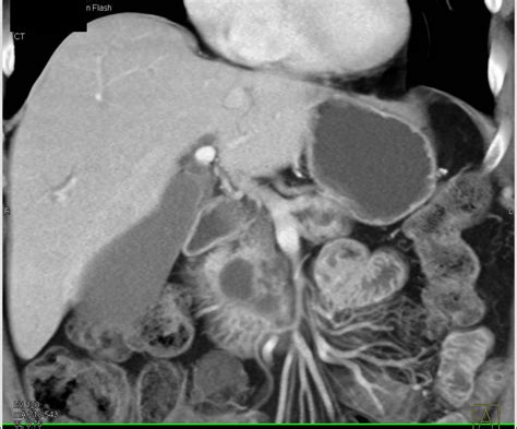 Pancreatic Adenocarcinoma With Duct Obstruction Pancreas Case Studies