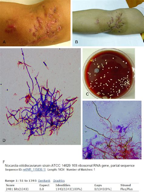 Figure 1 From A Protracted Primary Cutaneous Nocardiosis Due To