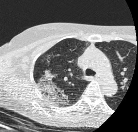 Pulmonary Hemorrhage Radiology Reference Article Radiopaedia Org The