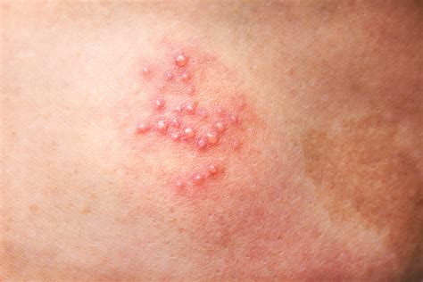 At Home Treatments For Shingles Painscale