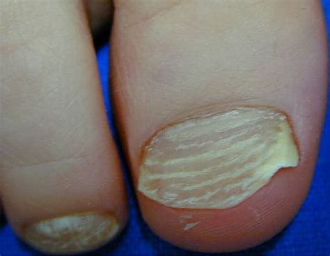 Superficial White Onychomycosis—a Syndrome With Different Fungal Causes