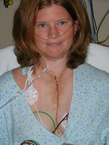 Heart Transplant Surgery Scar