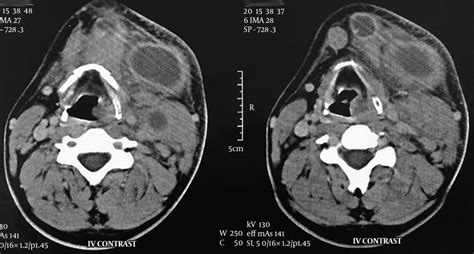 Ct Scan Neck Lymph Node Anatomy