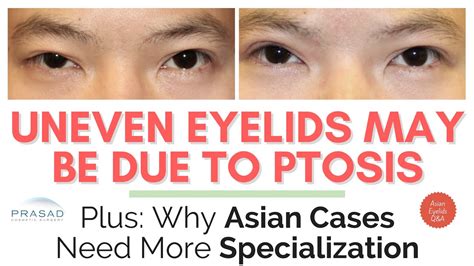 why uneven eyelids may be due to ptosis and differences in correction for asian eyelids youtube