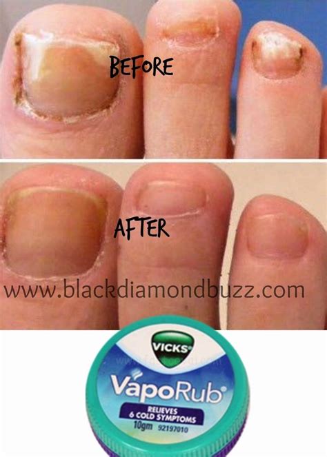 Don't take oral meds they will ruin you liver. Vicks Vapor Rub Nail Fungus in 2020 (With images) | Vicks ...