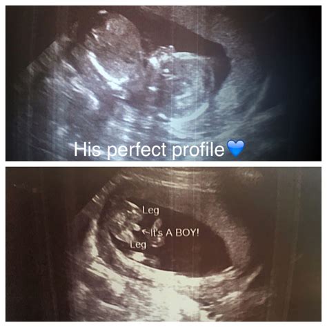 Ultrasound Pictures Of Baby Boy At 16 Weeks Febabys