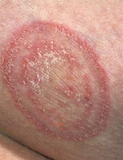 Natural Fungal Infection Treatment With Essential Oils